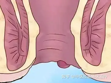 肛肠病肛门口脱出的小肉球到底是什么