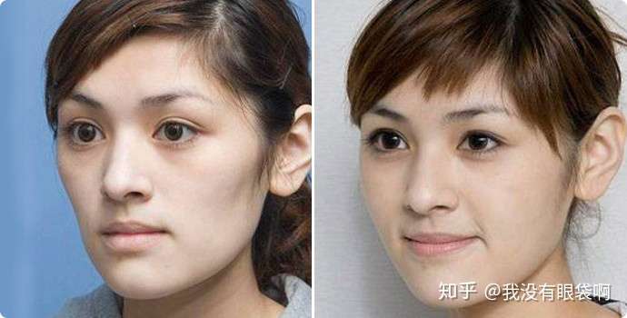 面部扁平可以用润致玻尿酸来打造立体感吗?