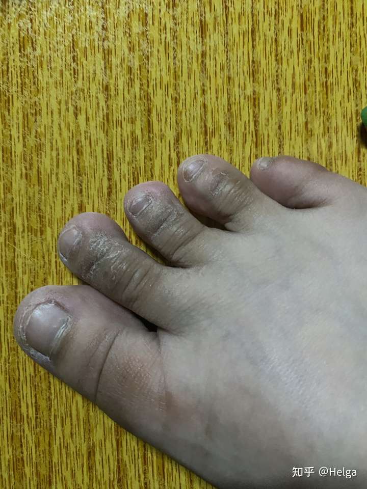 指关节哪里黑黑的 大概是我老曲着脚趾的原因 要怎么办?