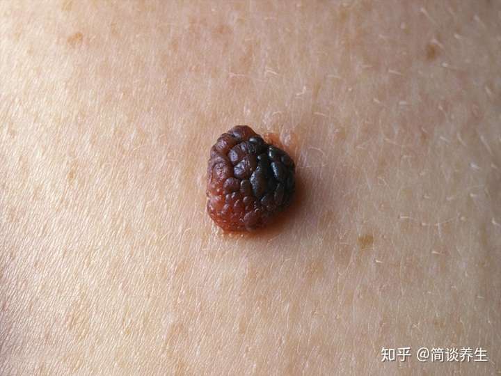 女子竟因一颗痣险些丢命有这5种特征的痣千万要警惕了