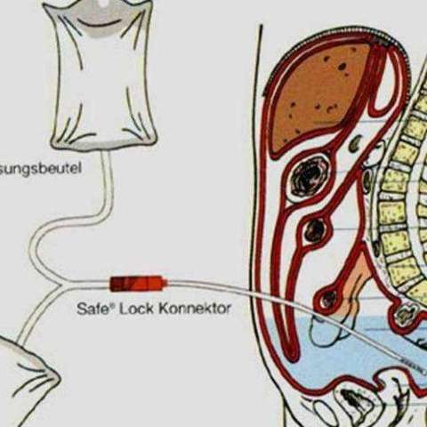 腹膜透析