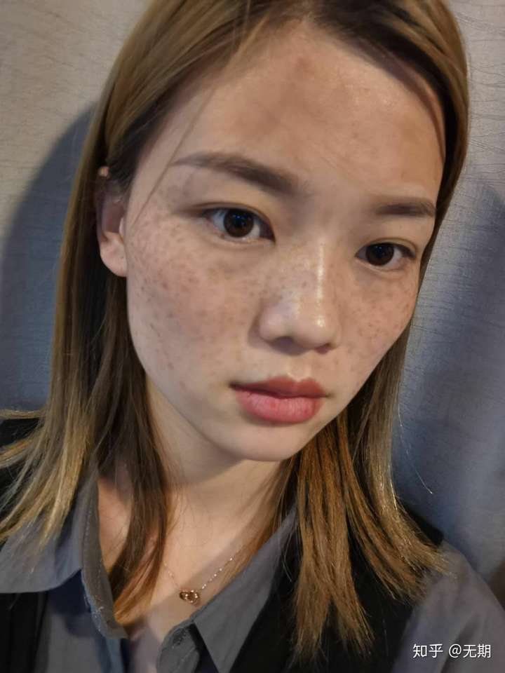 多年的麻子脸终于好了