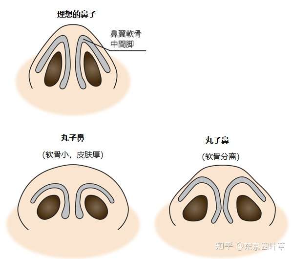 日本整形 鼻子到底怎么弄才好 看这篇贴子就够了 知乎