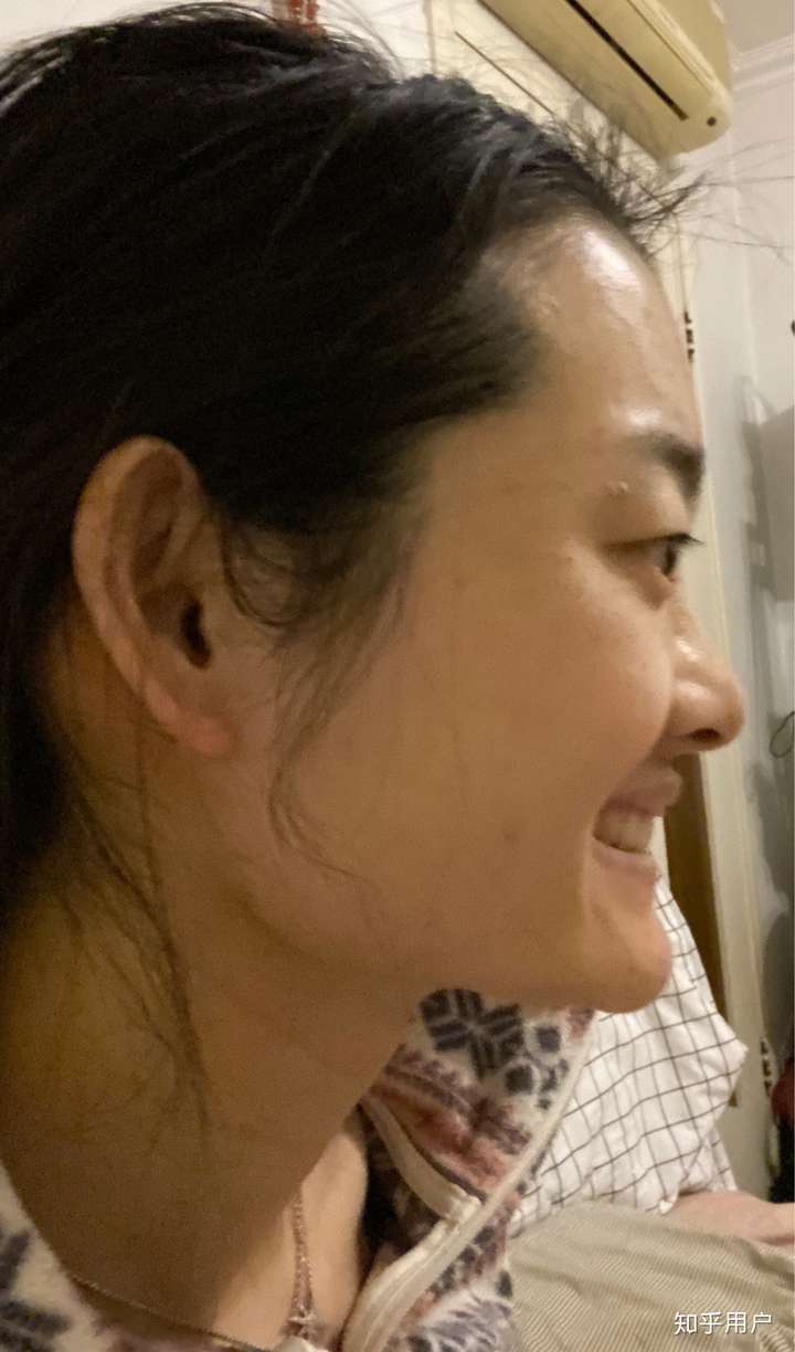 月亮脸,面中凹陷,下巴突出,很丑很自卑,请问正颌手术能改变我的脸型吗