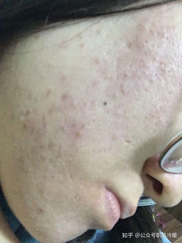 闭口怎么形成的 怎么去 知乎