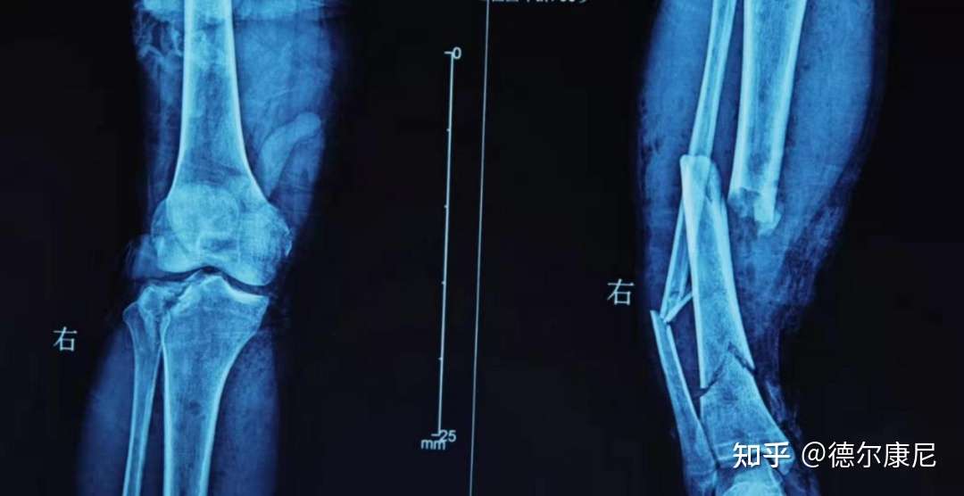 骨折术后一年多 骨头一直长不好该怎么办 知乎