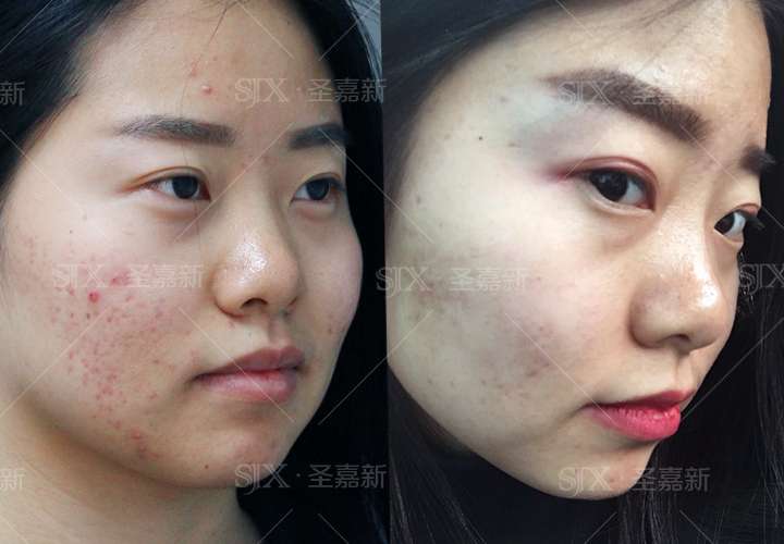 怎么能控制住手不摸脸上的痘痘?
