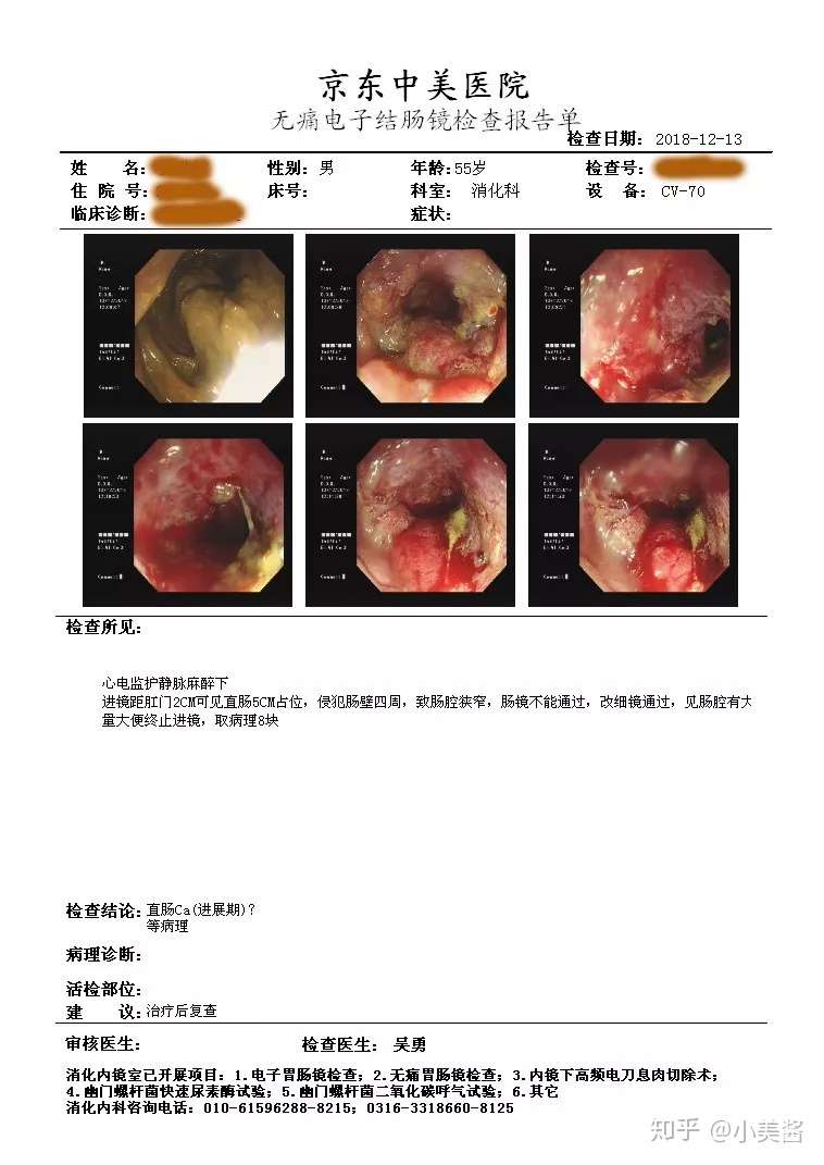 肠癌多是 拖 出来的 重视3多2痛 或许还不晚 知乎