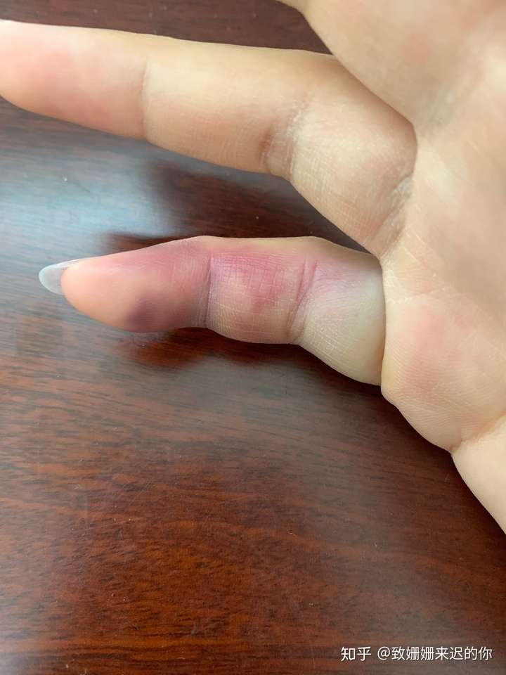 手指肌腱断裂最后一节无法伸直医生教我不要治疗了请问我该怎么做不