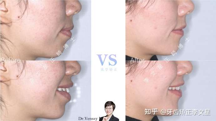成都牙齿矫正丨骨性双颌前突 矫正后还拥有了一个饱满的侧面苹果肌 少女感up 知乎