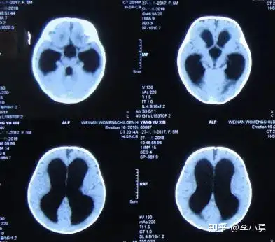 家属发现宝宝间断出现双眼眼球下旋(落日征)表现,并且测量
