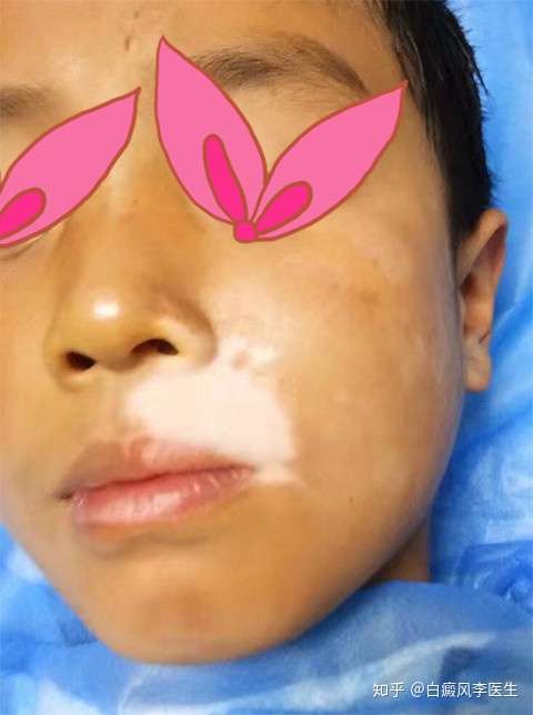 一场手术后,得了白癜风,嘴唇很明显,用口红可以遮盖一些,初上大学,真