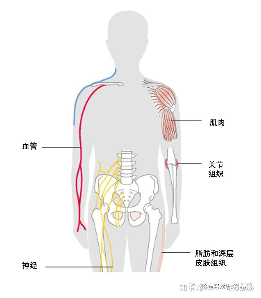 一文读懂软组织肉瘤的分类 家族遗传 患病风险 症状和体征 知乎