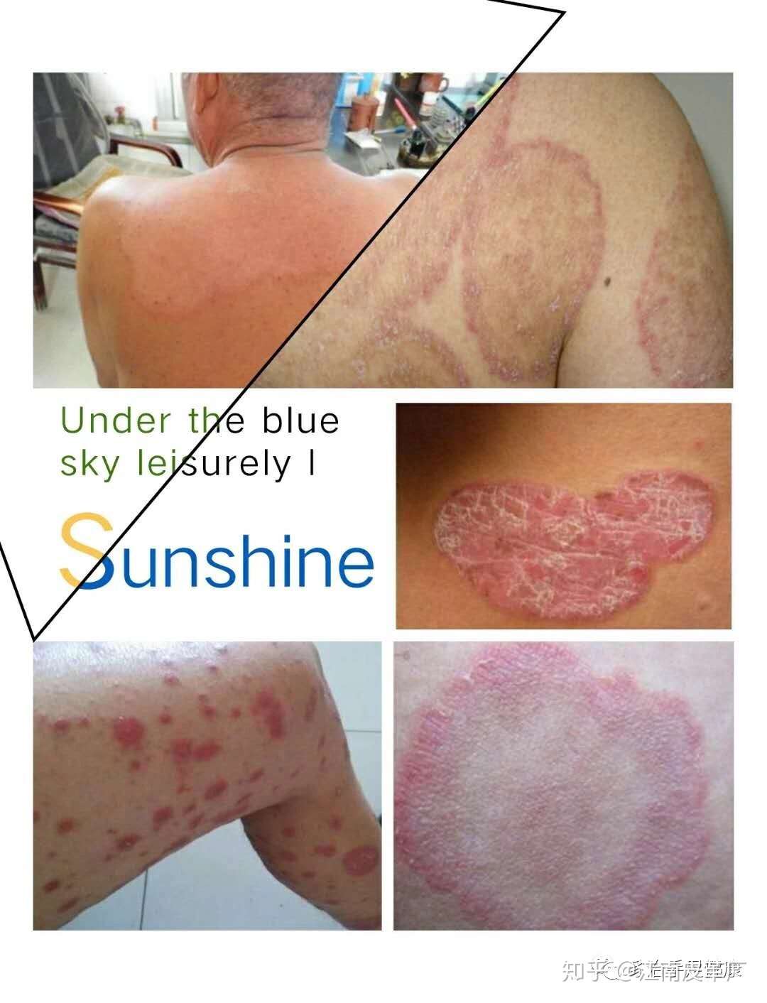 各种脚部问题 皮肤病案例对照表 知乎