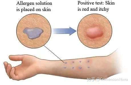 详解孩子过敏性鼻炎和处理方法 家长多了解 对症治疗 知乎