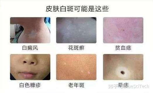 大多数的白癜风初期症状表现为一种无症状的白斑,不痛不痒.