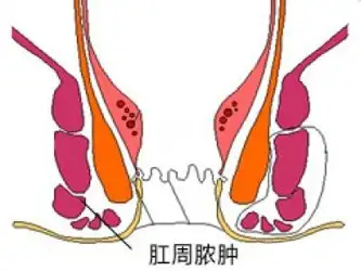 肠窦炎图片