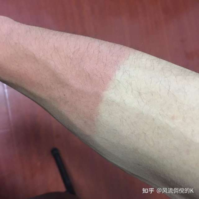 皮肤经太阳暴晒后,如何正确护肤?