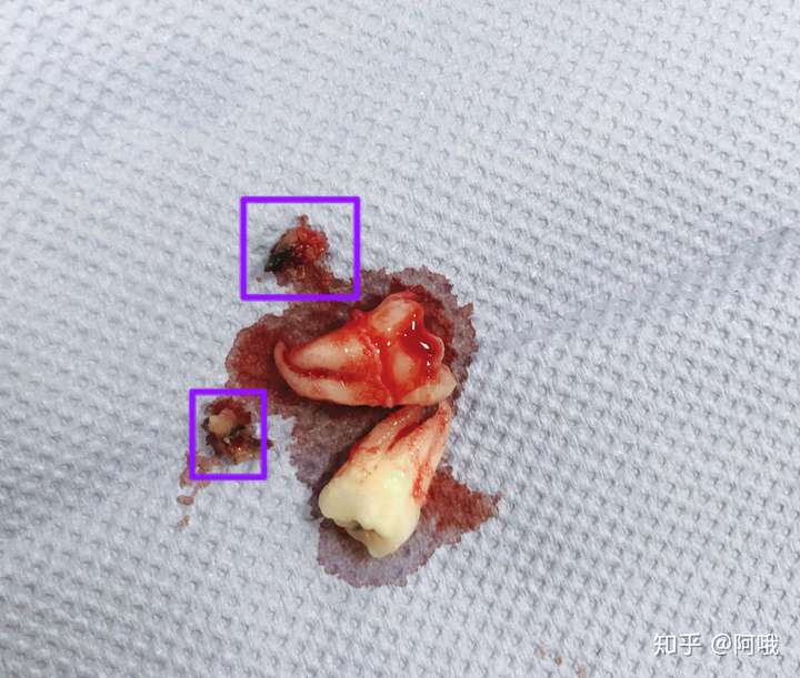 第一次拔智齿 - 知乎