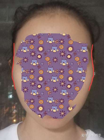 请问这是颧骨外扩还是太阳穴凹陷呀?