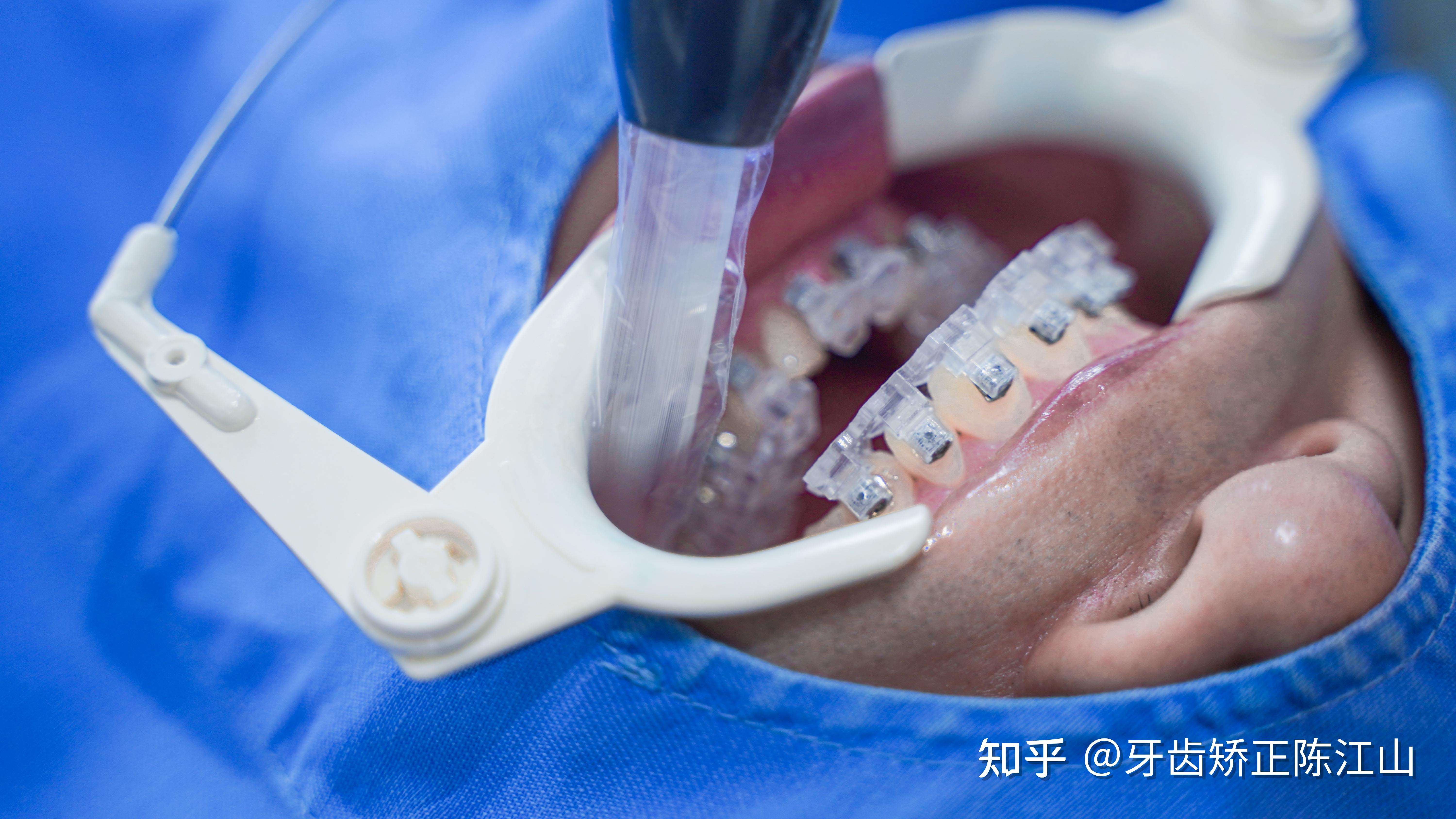q陈医生全口托槽是你粘还是助理粘