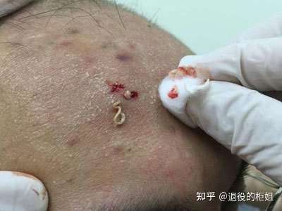 请各位大佬帮我看下,这是黑头还是什么,我该怎么办,谢谢.