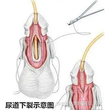 小儿尿道下裂是儿童泌尿生殖系统最常见的畸形之一.