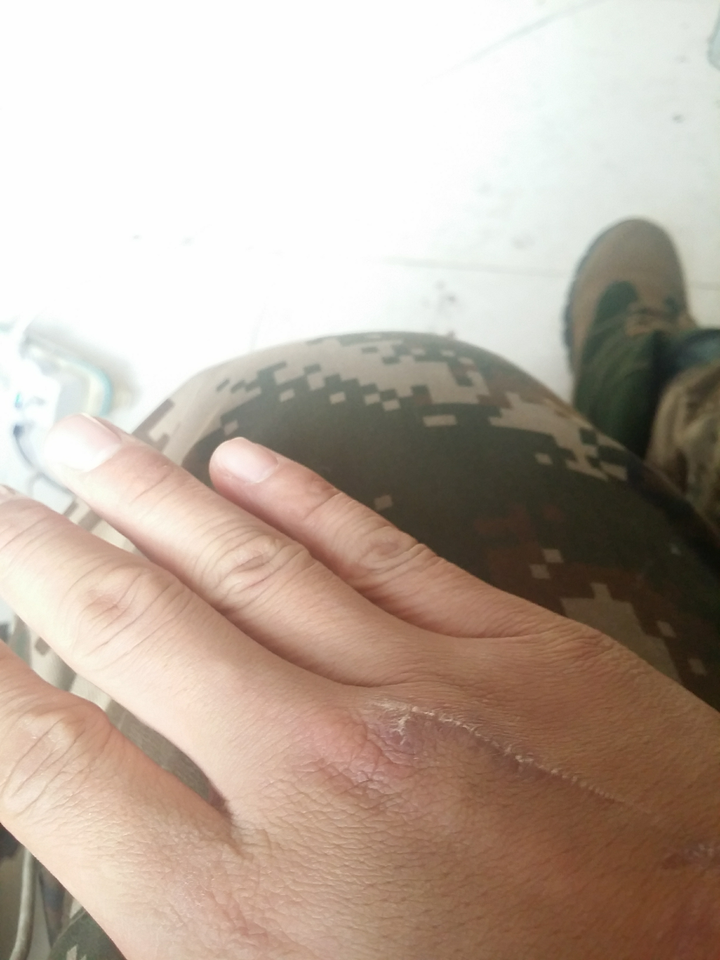 刀划伤了手背,有什么方法可以处理吗?