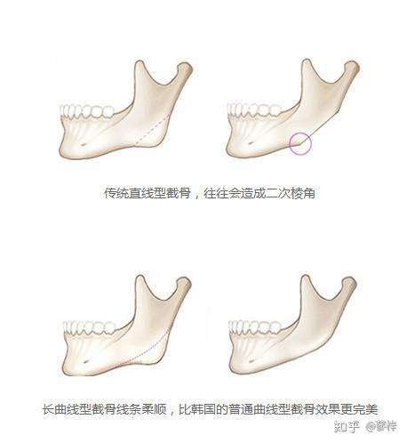 整容手术中削骨跟磨骨有什么区别价钱多少多长时间恢复手术的后遗症