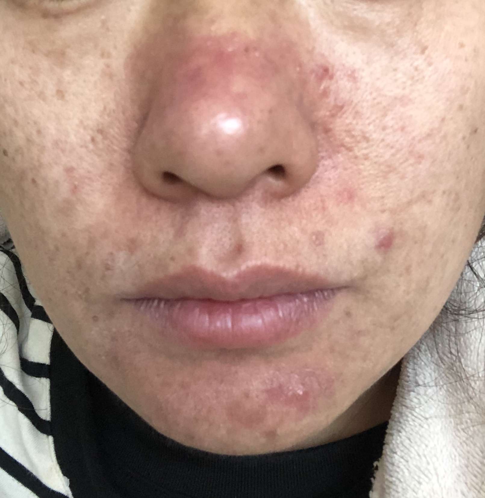 调皮有道李志忠 的想法: #玫瑰痤疮 #酒渣鼻 玫瑰痤疮的古籍记载