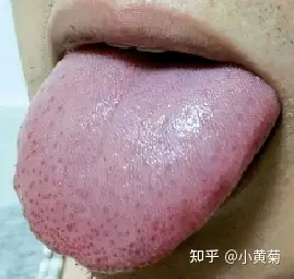 一份红一份热——点刺舌舌象 