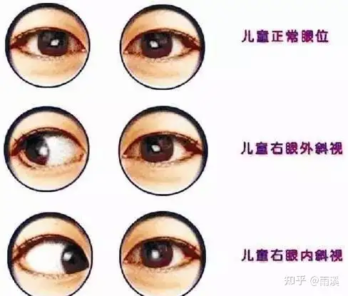 弱视是什么 知乎