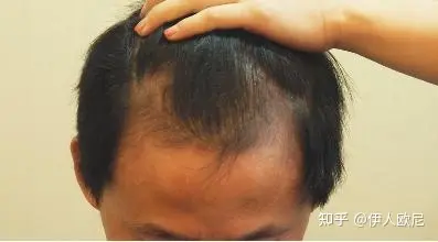 男性m型脱发的两种原因以及治疗方法