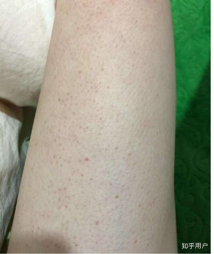 腿上有黑点点 汗毛长不出来 不痒不痛 女孩子 是遗传的 可咋整啊?