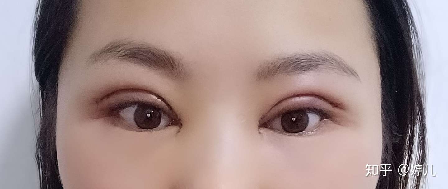坐标哈尔滨双眼皮全切恢复过程 知乎