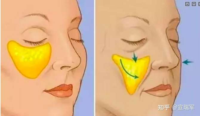 法令纹深是因为脸部肌肉下垂,尤其是苹果肌(笑肌)下垂,而且会导致眼睛