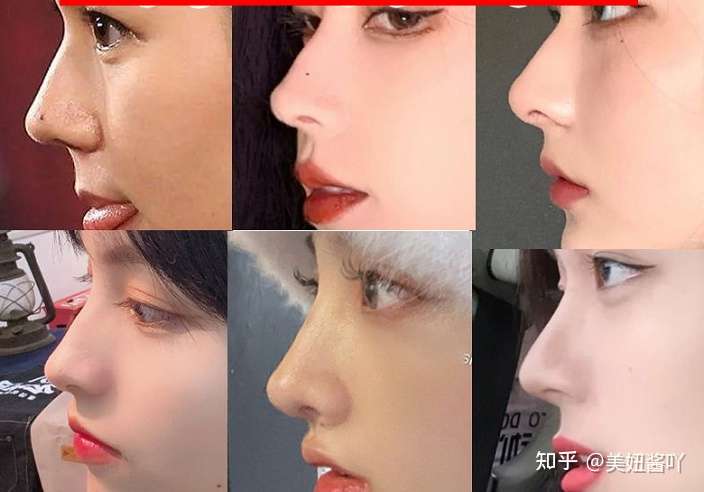 直鼻和翘鼻到底应该怎么选?