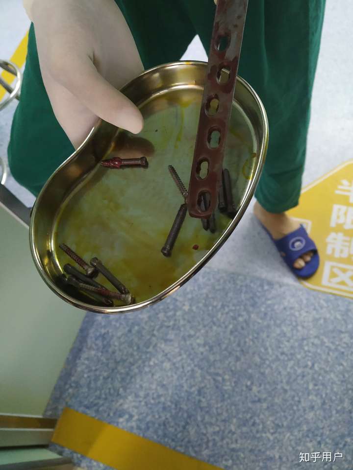 感谢大家的鼓励啦～今天上午成功把在我体内快五年的钢板取了出来
