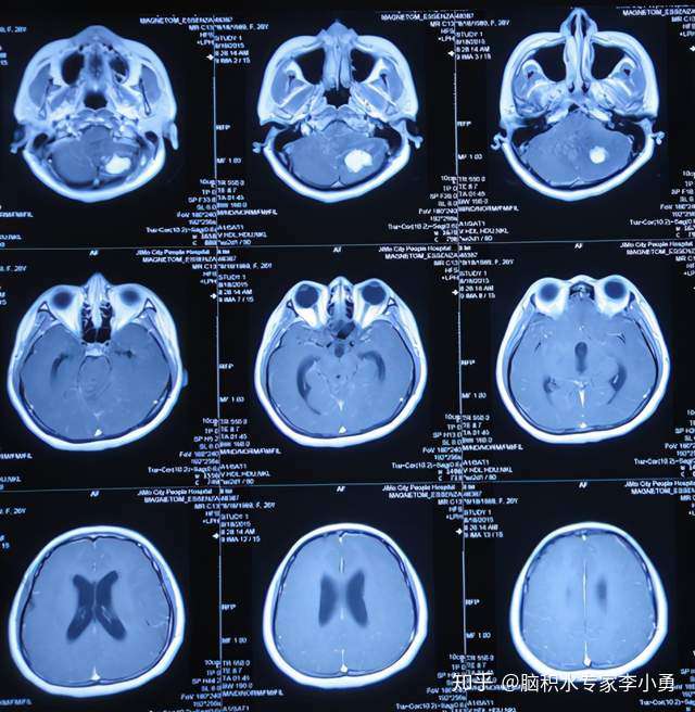 小腦血管母細胞瘤伴小腦扁桃體下疝脊髓空洞症腦積水及早在李小勇