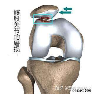 髌骨软化的正确处理方式