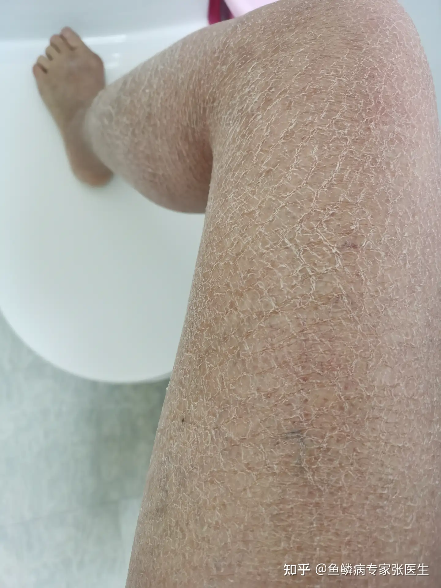 天生就有鱼鳞病 这个可以根治吗 知乎