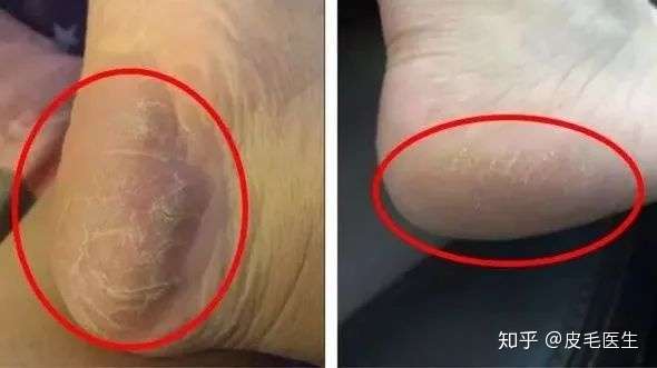 脚部干裂蜡黄死皮堆积老茧丛生为什么明明才18岁却有一双奶奶脚