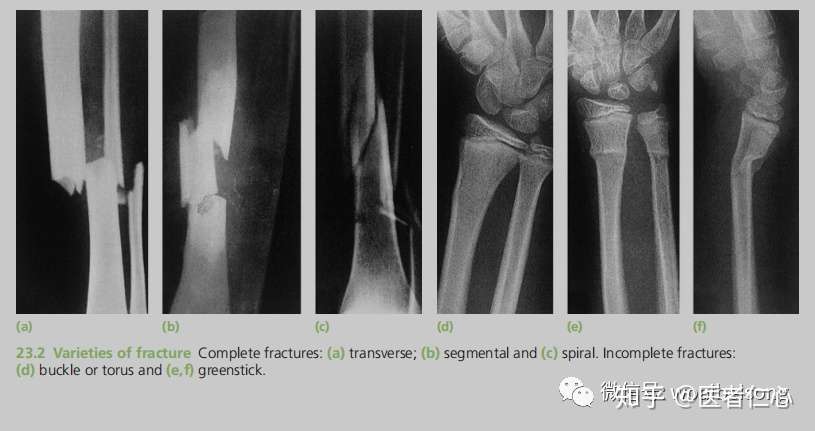 骨科英文书籍精读 2 骨折分型 知乎
