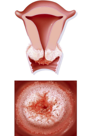 其实不用过于担心,宫颈糜烂并没有我们想象的那么可怕.
