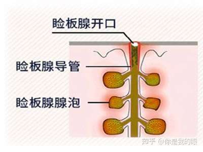 睑板腺一旦堵塞,想要疏通是不是非常难? - 知乎