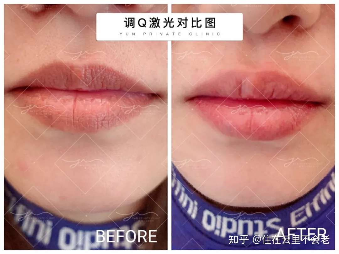 黑胳膊肘和黑膝盖 应该如何改呢 知乎