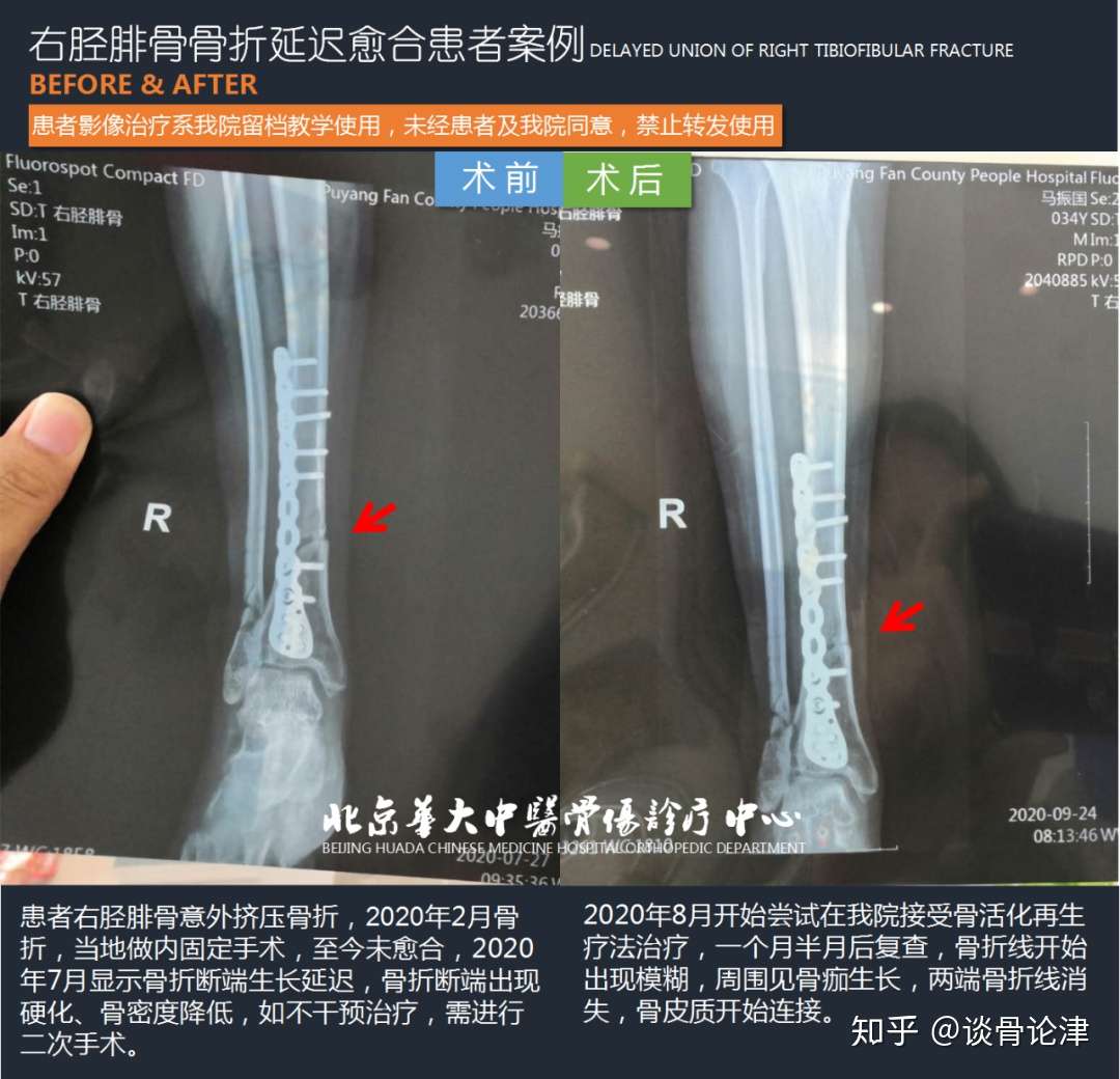 右胫腓骨骨折延迟愈合治疗案例及胫腓骨骨折康复指导 知乎
