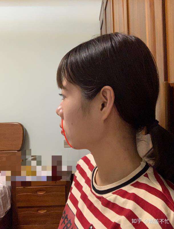 注射玻尿酸和矫正牙齿来治疗下巴后缩各有什么利弊风险呢?