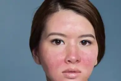 激素依赖性皮炎冬季应该如何护理?
