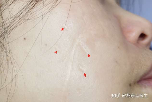 真的很讨厌这种蜈蚣脚疤痕处理很棘手